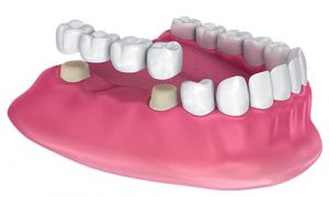 dental_crown_bridge