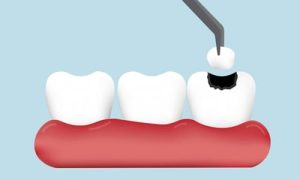 dental_fillings